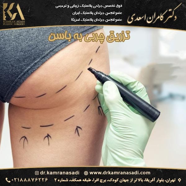 تزریق چربی به باسن 