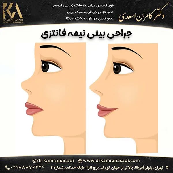 جراجی بینی نیمه فانتزی https://drkamranasadi.com/