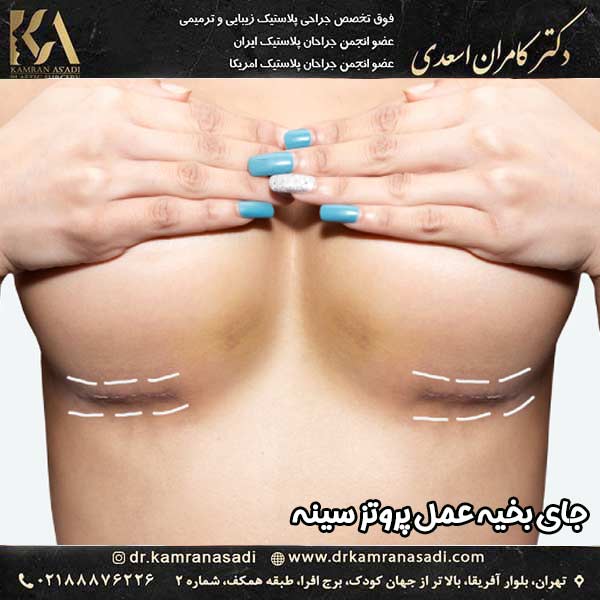 جای بخیه عمل پروتز سینه