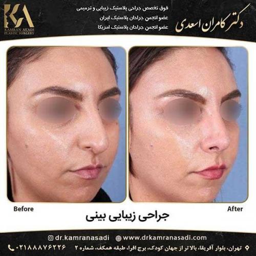 جراحی-بینی-دکتر-اسعدی--1-20