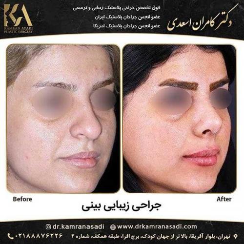 جراحی-بینی-دکتر-اسعدی--1-21