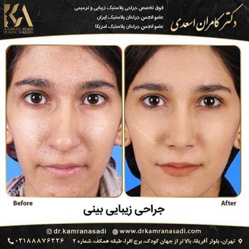 جراحی-بینی-دکتر-اسعدی--1-22
