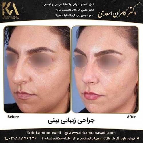 جراحی-بینی-دکتر-اسعدی--2-20
