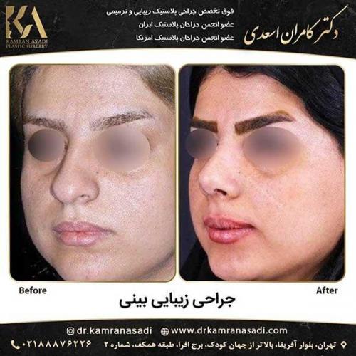 جراحی-بینی-دکتر-اسعدی--2-21