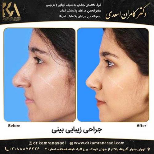جراحی-بینی-دکتر-اسعدی--2-22