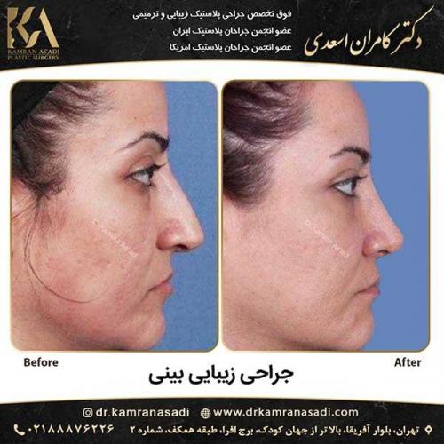 جراحی-بینی-دکتر-اسعدی--2-23