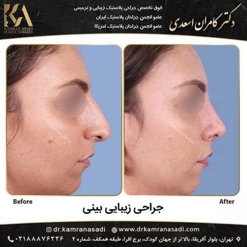 جراحی-بینی-دکتر-اسعدی--3-20