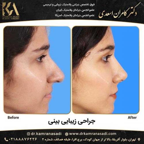 جراحی-بینی-دکتر-اسعدی--3-22