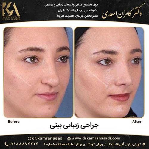 جراحی-بینی-دکتر-اسعدی--3-23