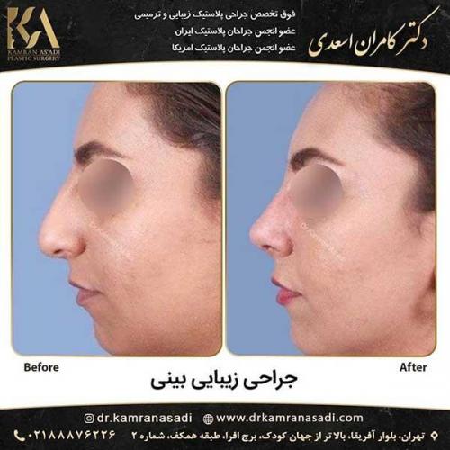 جراحی-بینی-دکتر-اسعدی--4-20