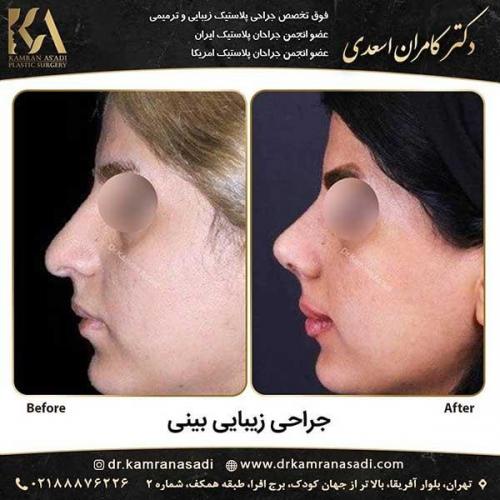 جراحی-بینی-دکتر-اسعدی--4-21