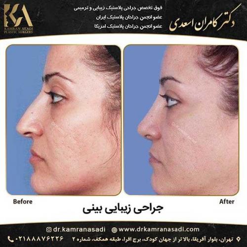 جراحی-بینی-دکتر-اسعدی--4-23