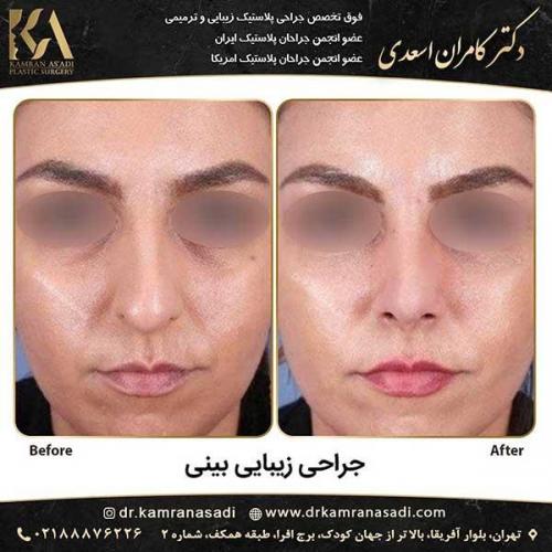 جراحی-بینی-دکتر-اسعدی--5-20