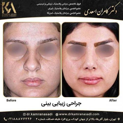 جراحی-بینی-دکتر-اسعدی--5-21