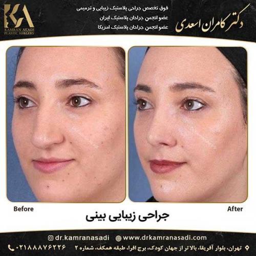 جراحی-بینی-دکتر-اسعدی--5-23