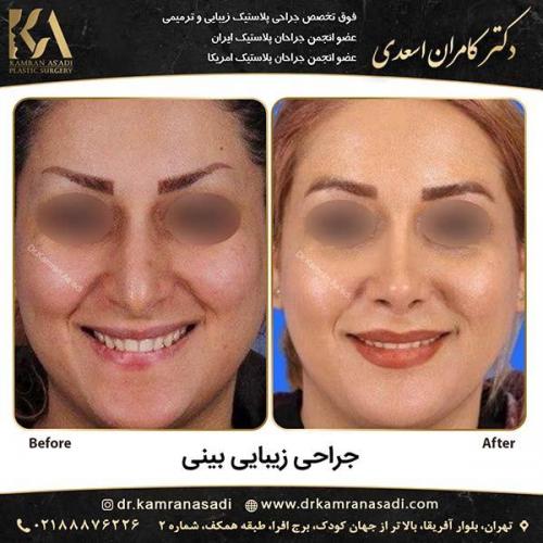 جراحی-بینی-دکتر-اسعدی-1-10