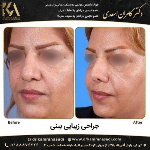 جراحی-بینی-دکتر-اسعدی-1-11