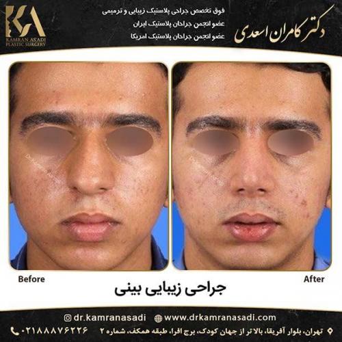 جراحی-بینی-دکتر-اسعدی-1-12