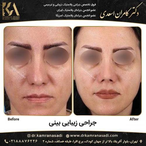 جراحی-بینی-دکتر-اسعدی-1-13