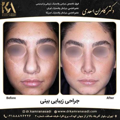 جراحی-بینی-دکتر-اسعدی-1-14