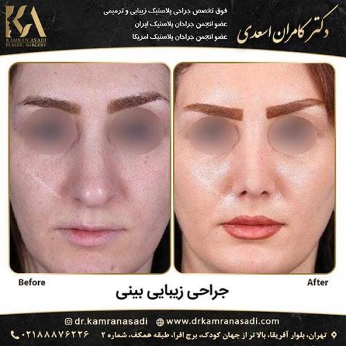 جراحی-بینی-دکتر-اسعدی-1-15
