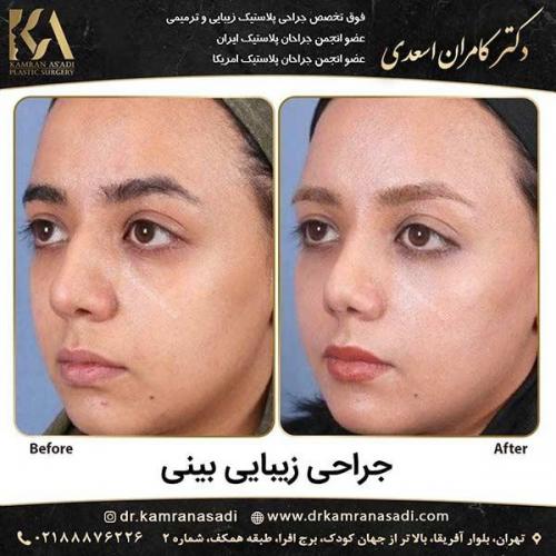 جراحی-بینی-دکتر-اسعدی-1-16
