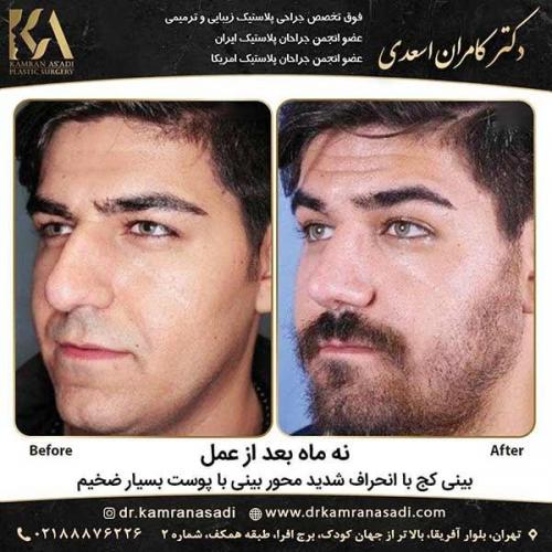 جراحی-بینی-دکتر-اسعدی-1-17