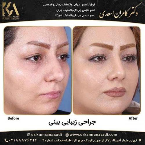 جراحی-بینی-دکتر-اسعدی-1-18