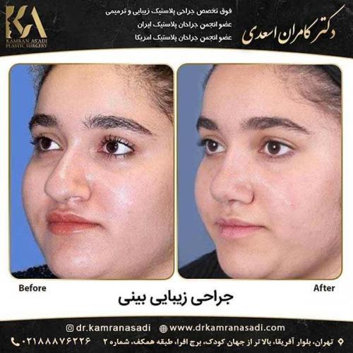 جراحی-بینی-دکتر-اسعدی-1-19