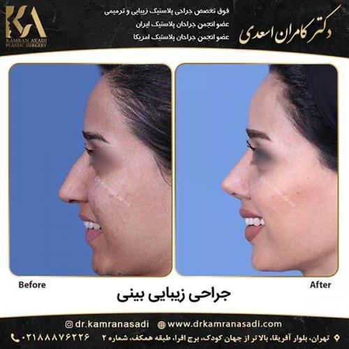جراحی-بینی-دکتر-اسعدی-1-2