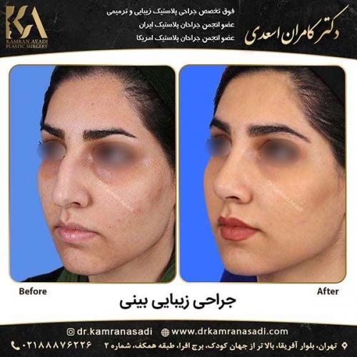 جراحی-بینی-دکتر-اسعدی-1-3