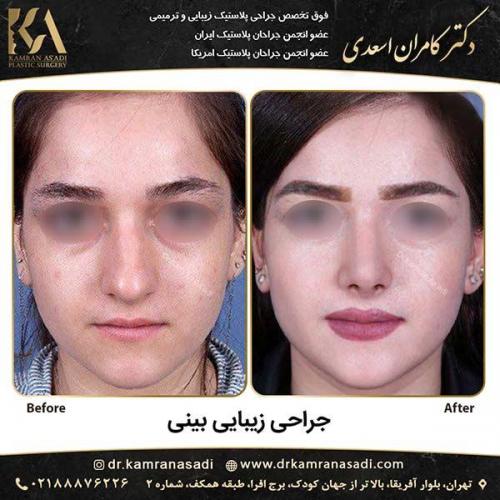 جراحی-بینی-دکتر-اسعدی-1-4