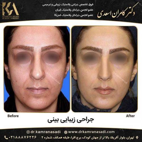 جراحی-بینی-دکتر-اسعدی-1-5