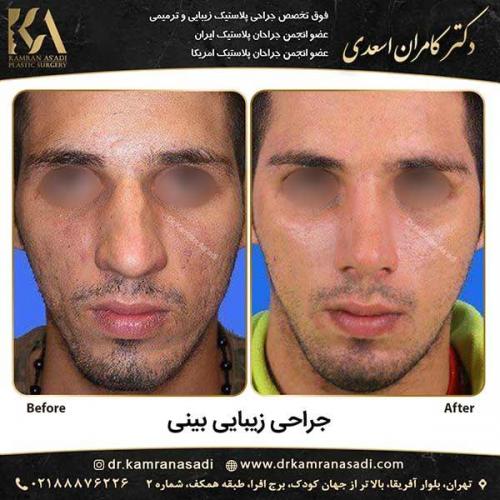 جراحی-بینی-دکتر-اسعدی-1-6