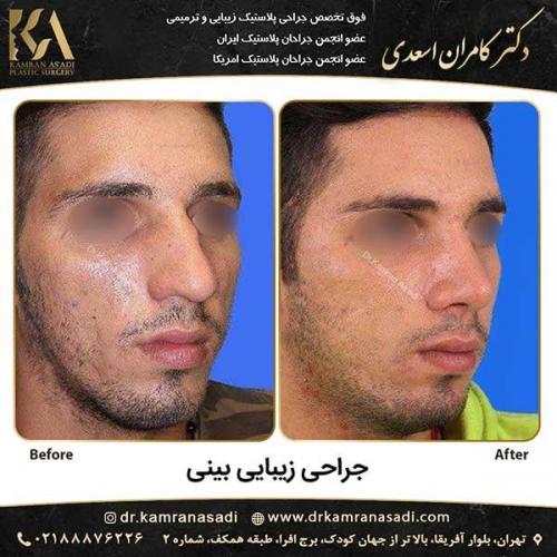 جراحی-بینی-دکتر-اسعدی-1-7