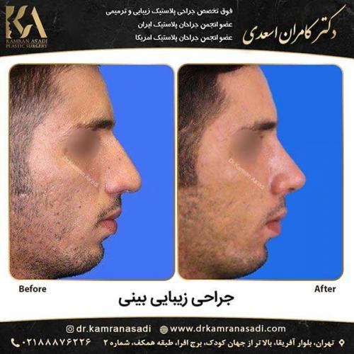 جراحی-بینی-دکتر-اسعدی-1-8