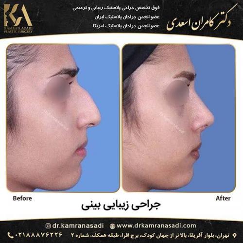 جراحی-بینی-دکتر-اسعدی-1-9