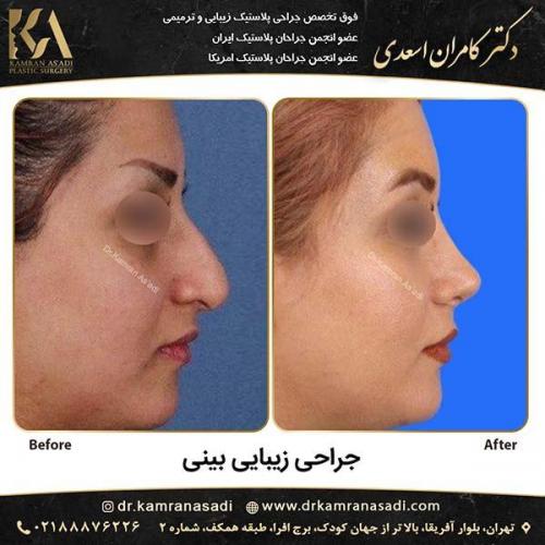 جراحی-بینی-دکتر-اسعدی-2-10