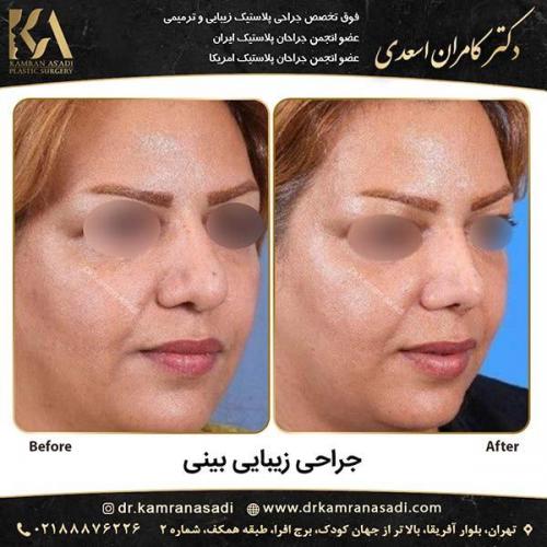 جراحی-بینی-دکتر-اسعدی-2-11