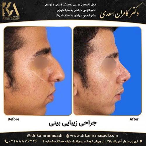 جراحی-بینی-دکتر-اسعدی-2-12