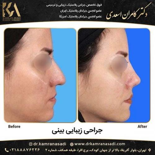 جراحی-بینی-دکتر-اسعدی-2-13