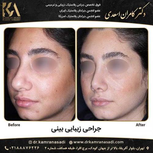 جراحی-بینی-دکتر-اسعدی-2-14