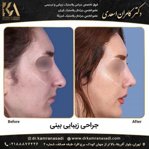 جراحی-بینی-دکتر-اسعدی-2-15