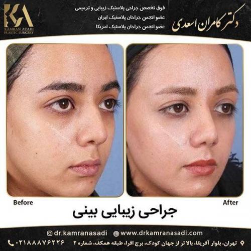 جراحی-بینی-دکتر-اسعدی-2-16