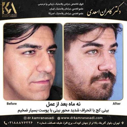 جراحی-بینی-دکتر-اسعدی-2-17