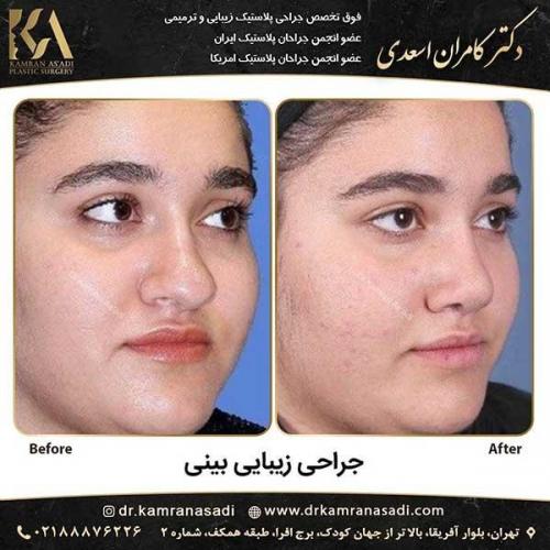 جراحی-بینی-دکتر-اسعدی-2-19