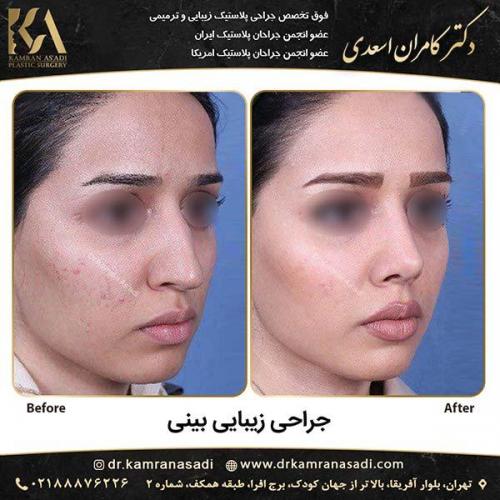 جراحی-بینی-دکتر-اسعدی-2-2