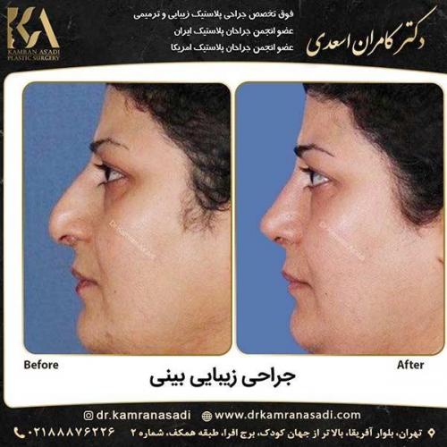 جراحی-بینی-دکتر-اسعدی-2-25