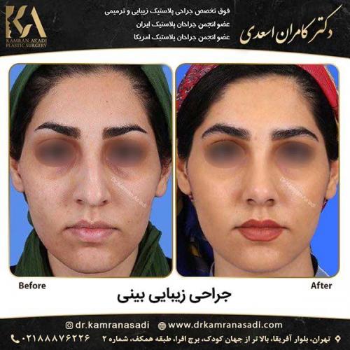 جراحی-بینی-دکتر-اسعدی-2-3