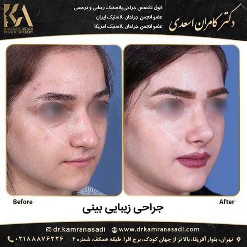 جراحی-بینی-دکتر-اسعدی-2-4